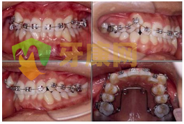 牙套戴牙套