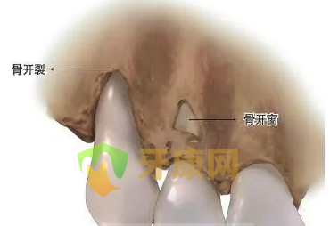 骨开裂图片