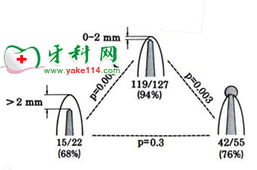 根管治疗