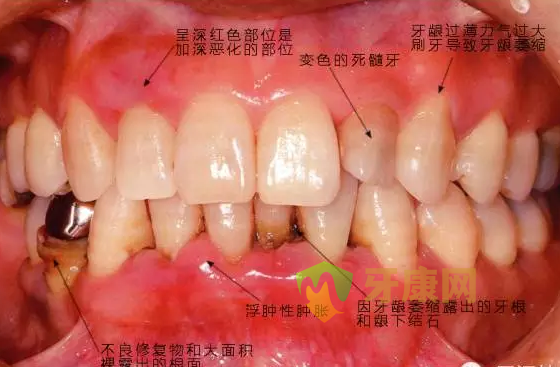 牙周病是什么样的