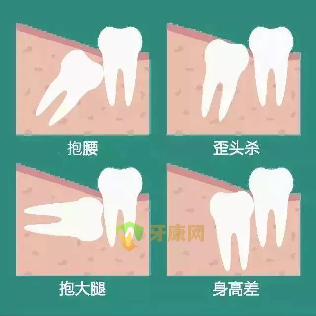 拔智齿最佳年龄段