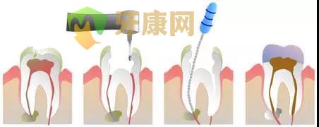 根管治疗后一定要做冠吗