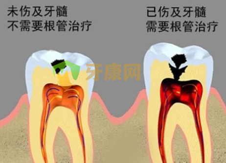 龋齿图片