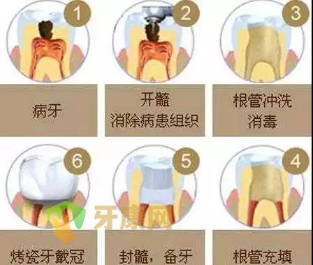 根管治疗后还会牙疼吗