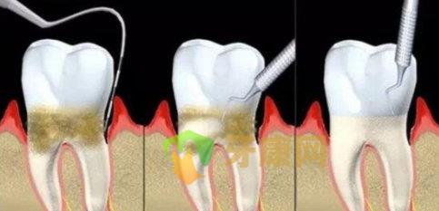 牙周病的发病原因