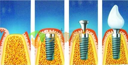 做种植牙修复好不好