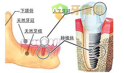 深圳即刻种植牙的费用