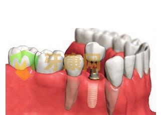 种植牙的年龄