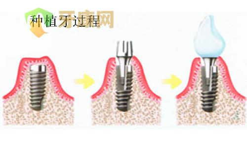 种植牙多少钱一颗