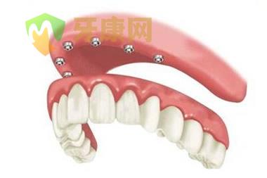 全口种植牙多少钱