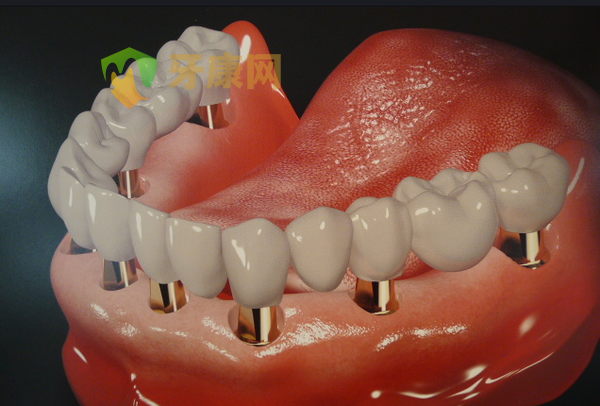 全口种植牙价格
