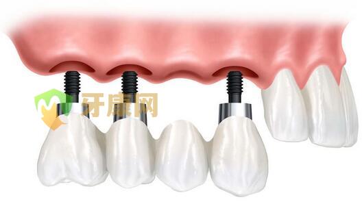 种植牙的缺点