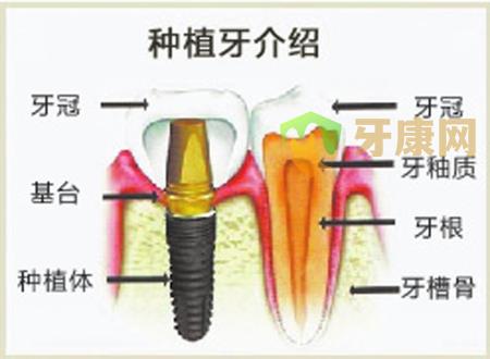 种植牙多少钱