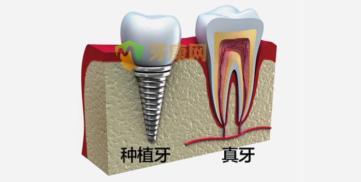 种植牙价格贵吗