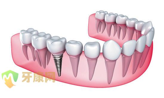 做种植牙有什么危害吗