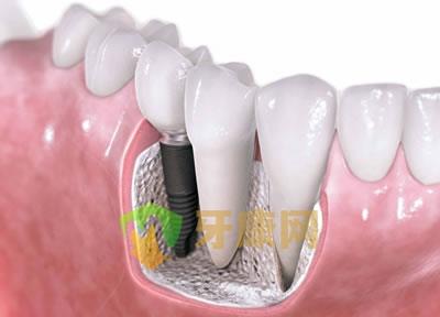 种植牙和真牙一样吗