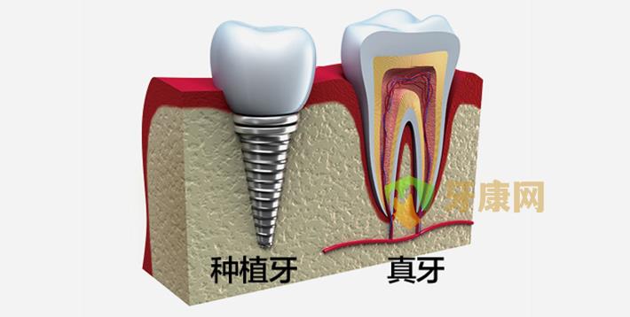 种牙存在危害吗