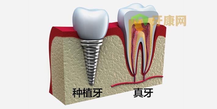 种植牙**需要注意什么