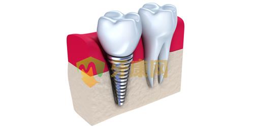 做种植牙的费用需要多少