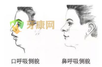 深圳儿童牙齿矫正贵吗