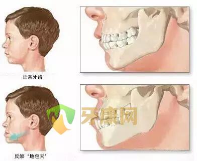 儿童牙齿长歪了需要做牙齿矫正吗