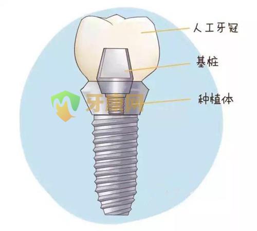  ankylos种植牙系统怎么样呢?