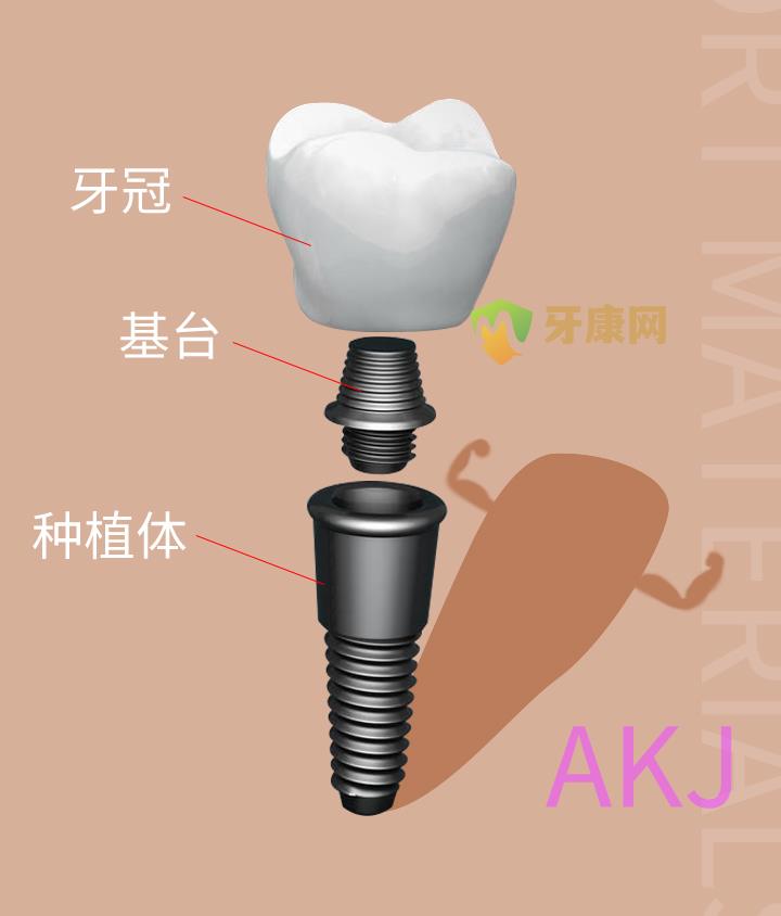 种植牙的结构