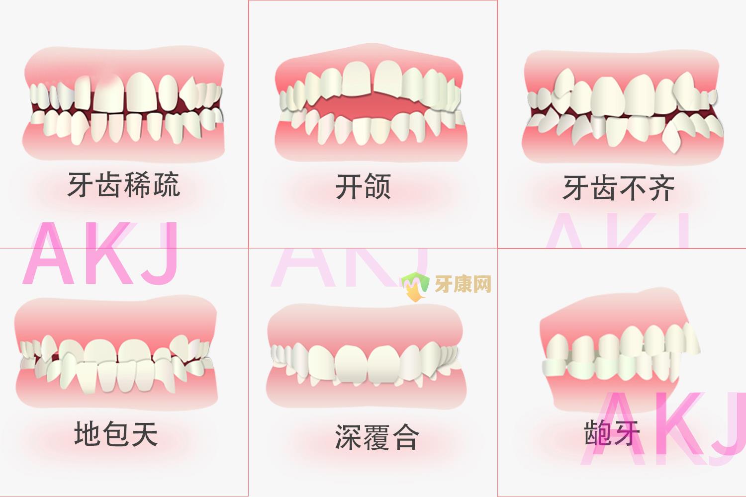 牙齿畸形类型