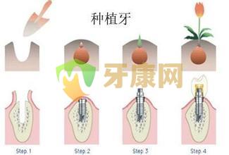 种植牙过程