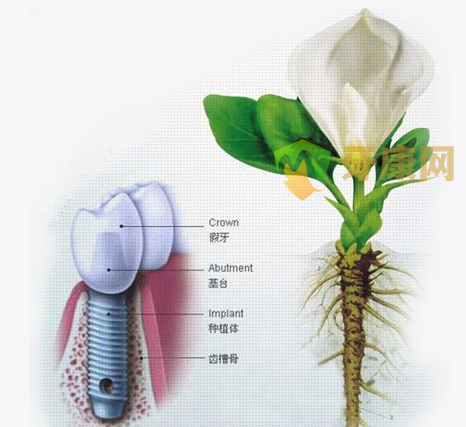 深圳牙康网种植牙