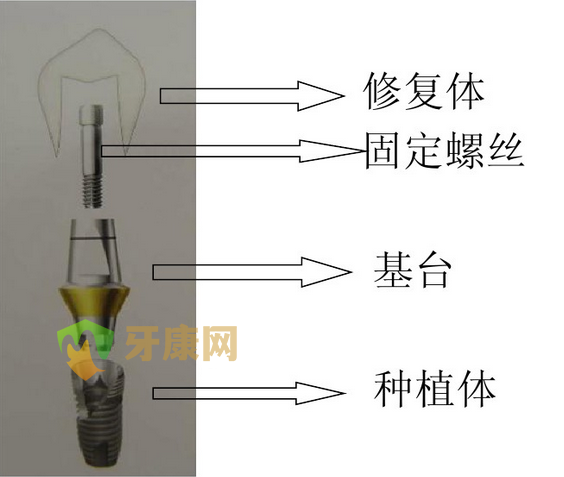 深圳牙康网口腔医院种植义齿