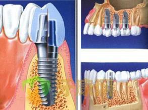 深圳牙康网种植义齿疼不疼？