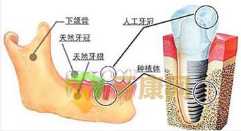 种植牙可以几颗一起做吗？