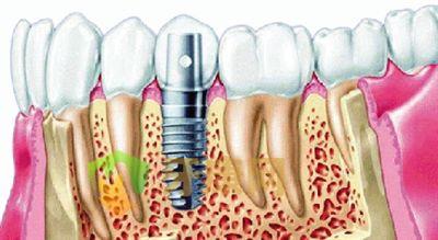 深圳种植牙