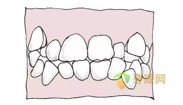 牙齿拥挤