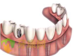牙齿缺失