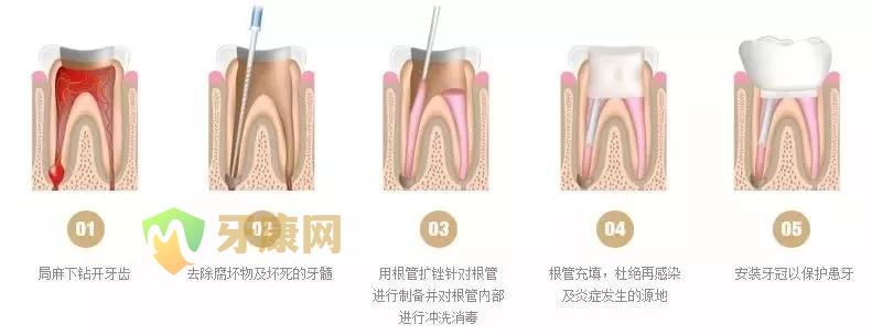 根管治疗