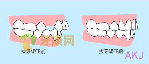 拔牙正畸示意图片