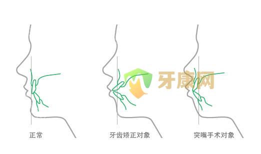 牙齿前突可以做烤瓷牙吗