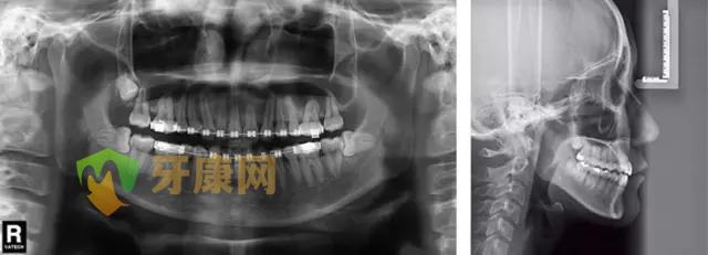 牙齿矫正要拍片吗