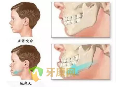   为何说儿童地包天3-5岁矫治比较好？