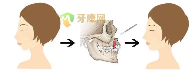 龅牙矫正价格