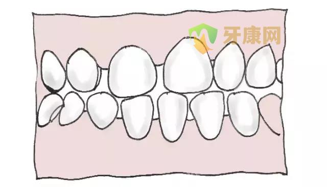 牙齿稀疏