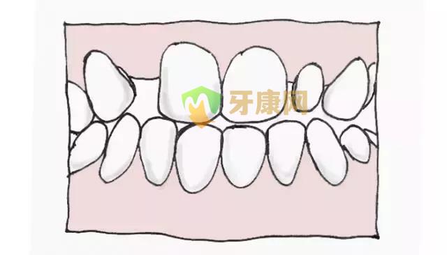 萌出异常