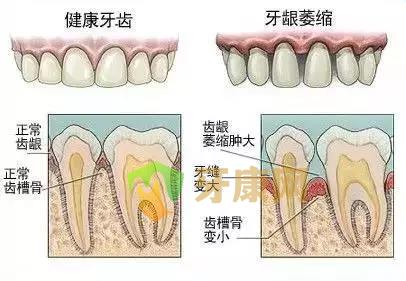 牙缝变大