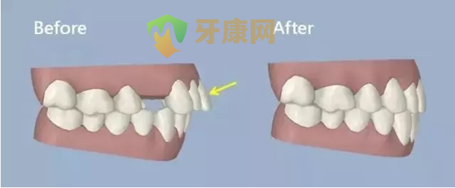 牙齿矫正哪些情况需要拔牙