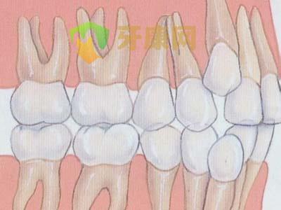 深圳牙齿拥挤怎么矫正？