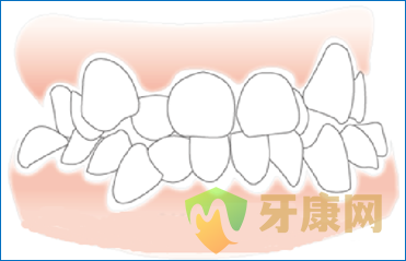  成人牙齿拥挤怎么治疗？