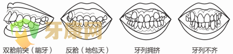 虎牙矫正什么方法结果比较好？