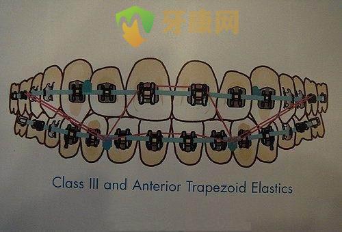 牙齿矫正过程中，可以自己调整橡皮筋吗？